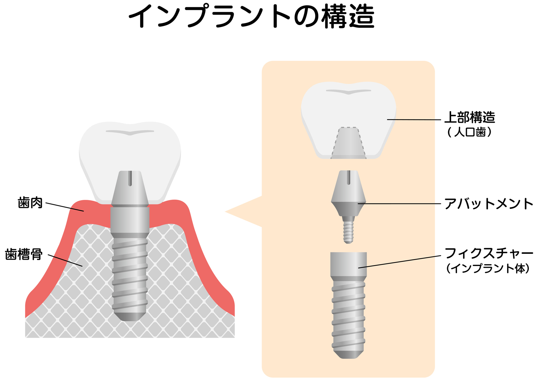 歯を失ってしまった方へ