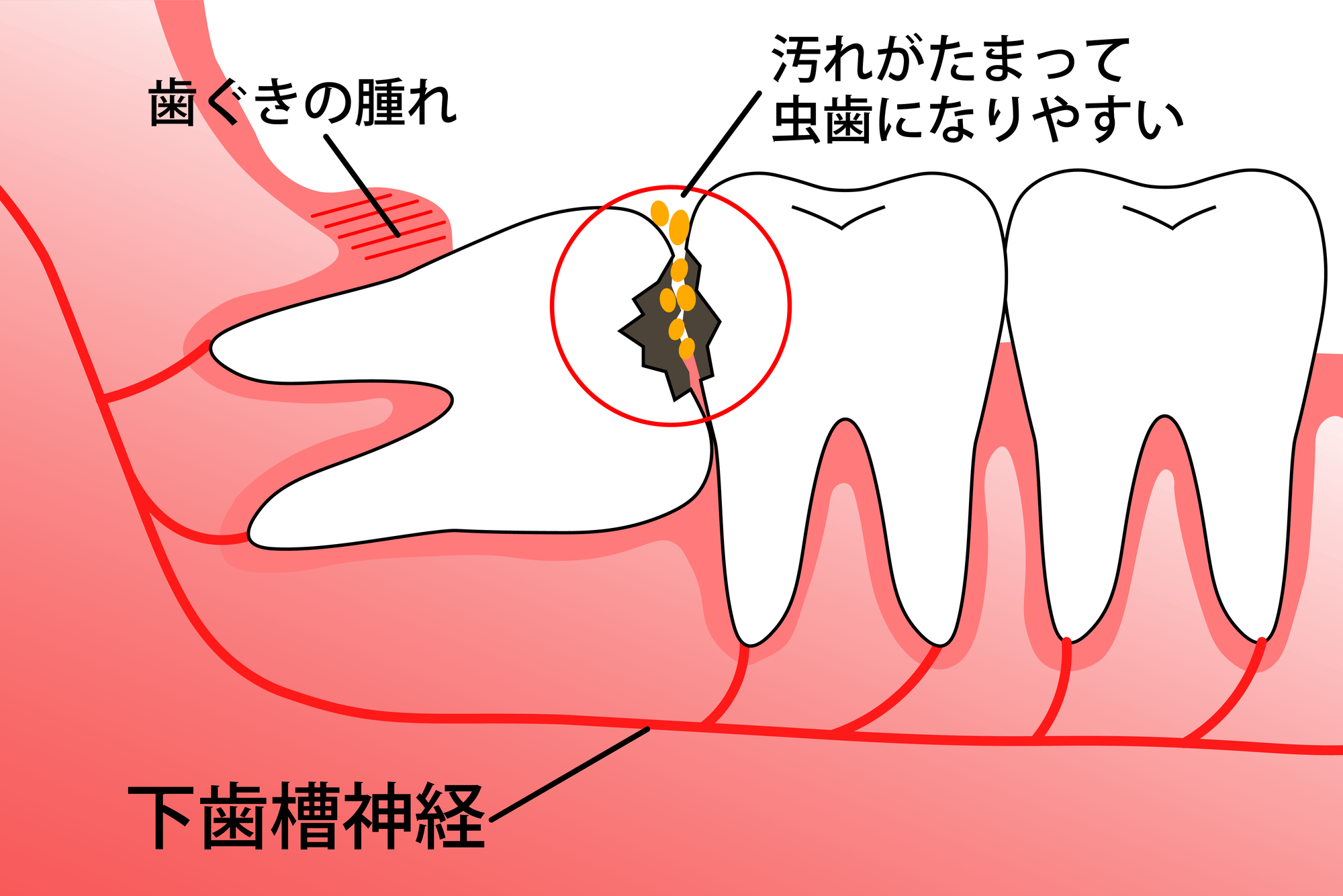 親知らずの抜歯