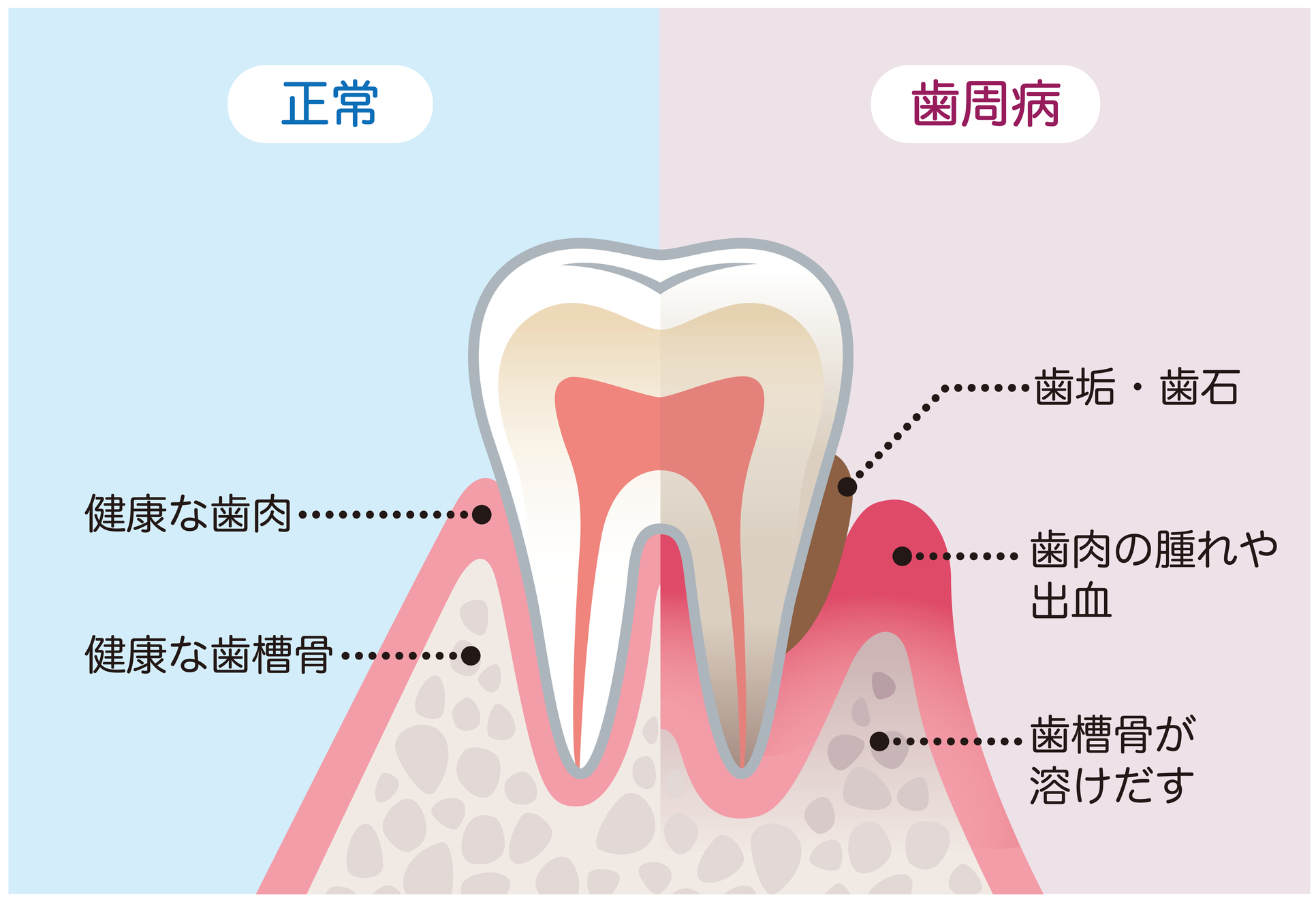 歯を失う原因になる歯周病