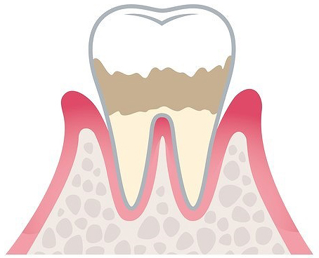 軽度歯周炎