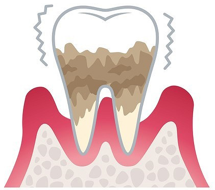 重度歯周炎